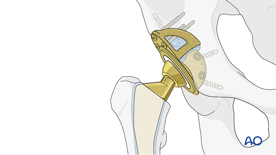 AO Surgery Reference periprosthetic hip fractures