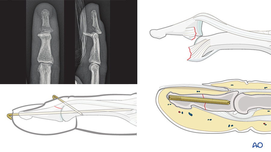 Hand distal phalanges