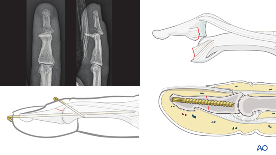 AO Surgery Reference update: Publication of Hand—Distal phalanges