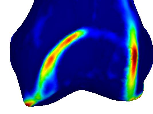 Figure 3: Curvature Maps - AP-view highlighting small structures with high curvature (i.e., medial and proximal trochlear ridge)