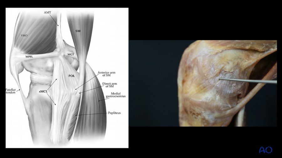 Anteromedial vs. posteromedial reconstructions