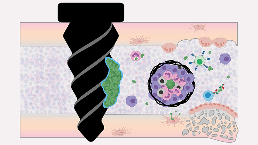 discoveries in osteomyelitis pathology