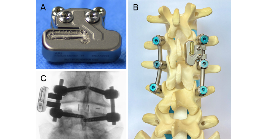 SmartFusion: Objective monitoring of spinal fusion via AO’s sensor technology for enhanced spinal care