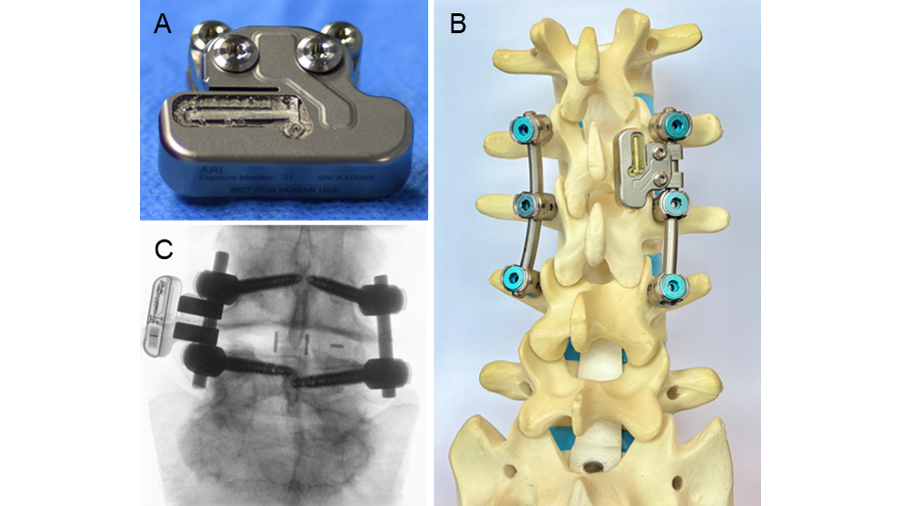 SmartFusion: Objective monitoring of spinal fusion via AO’s sensor technology for enhanced spinal care
