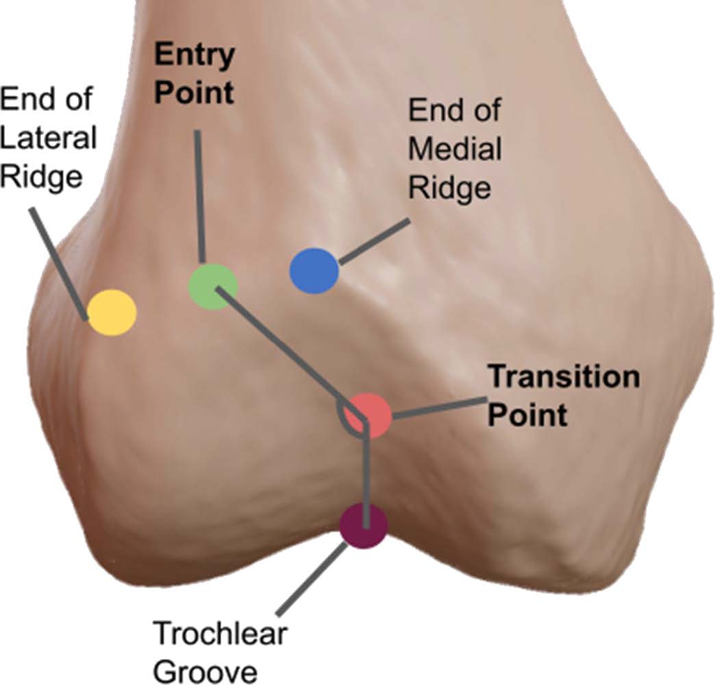 EP-TP Angle EP: midpoint of flattened proximal trochlea TP: point along trochlear groove where direction of the trochlear groove changes from oblique to vertical EP-TP Angle EP: midpoint of flattened proximal trochlea TP: point along trochlear groove where direction of the trochlear groove changes from oblique to vertical