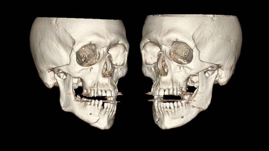 Mandibular fracture case discussion Mandibular fracture case discussion