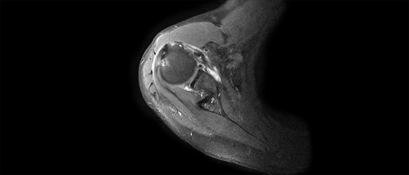 Scan of a shoulder joint