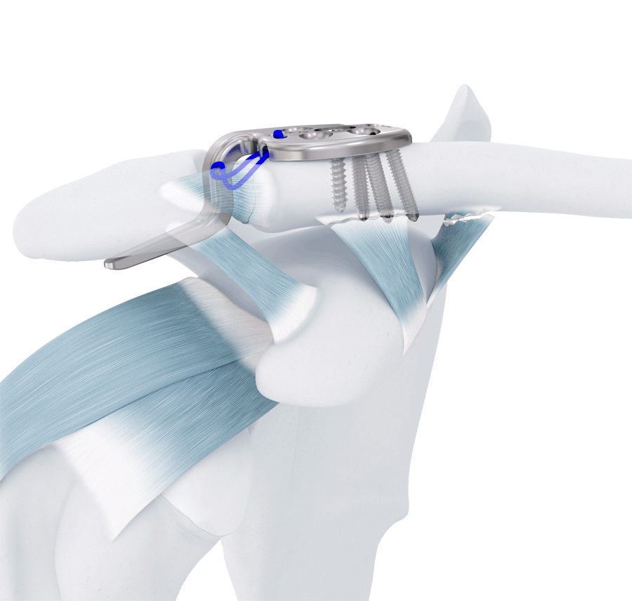 Hook plates and suture