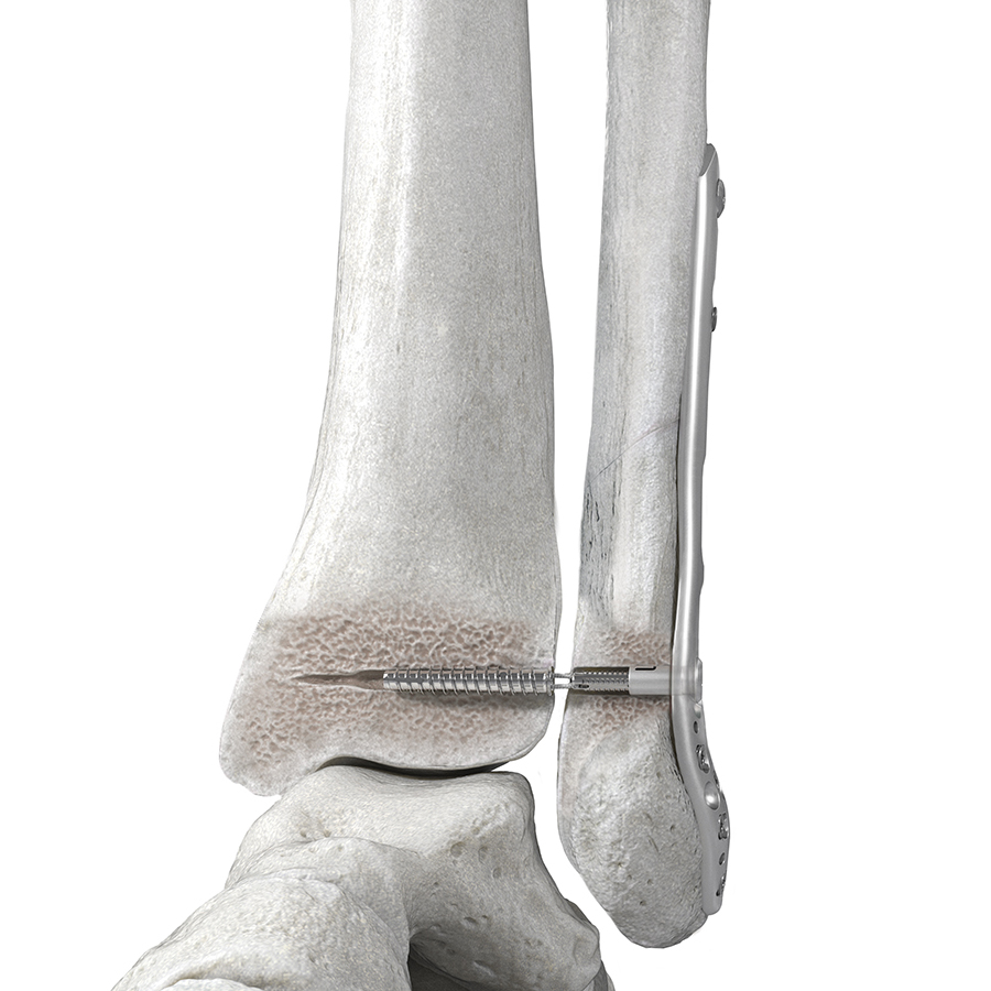 TightRope™ Fixation for Ankle Syndesmosis - Houston, TX: Spring