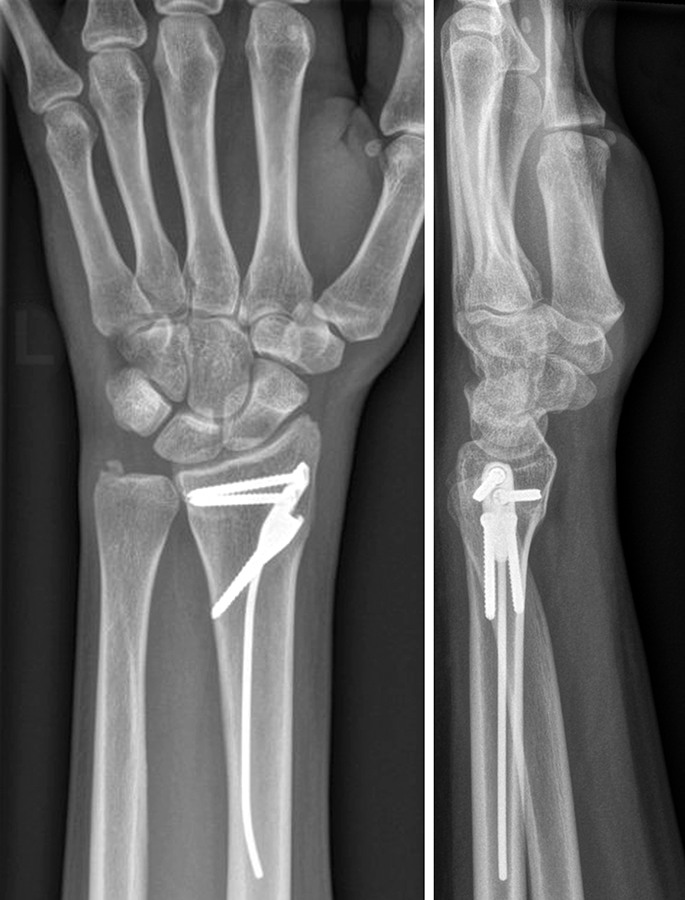 PDF) The titanium elastic nail serves as an alternative treatment for adult  proximal radial shaft fractures: a cohort study | Jenn-Huei Renn -  Academia.edu