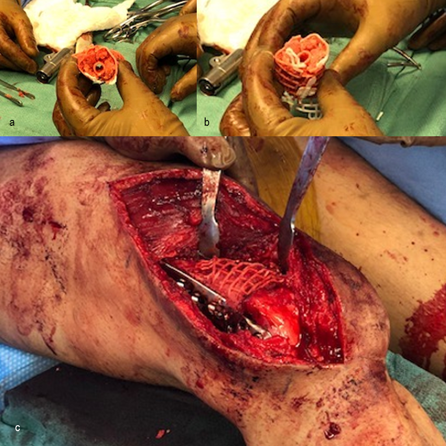 Revision surgery intra-op images
