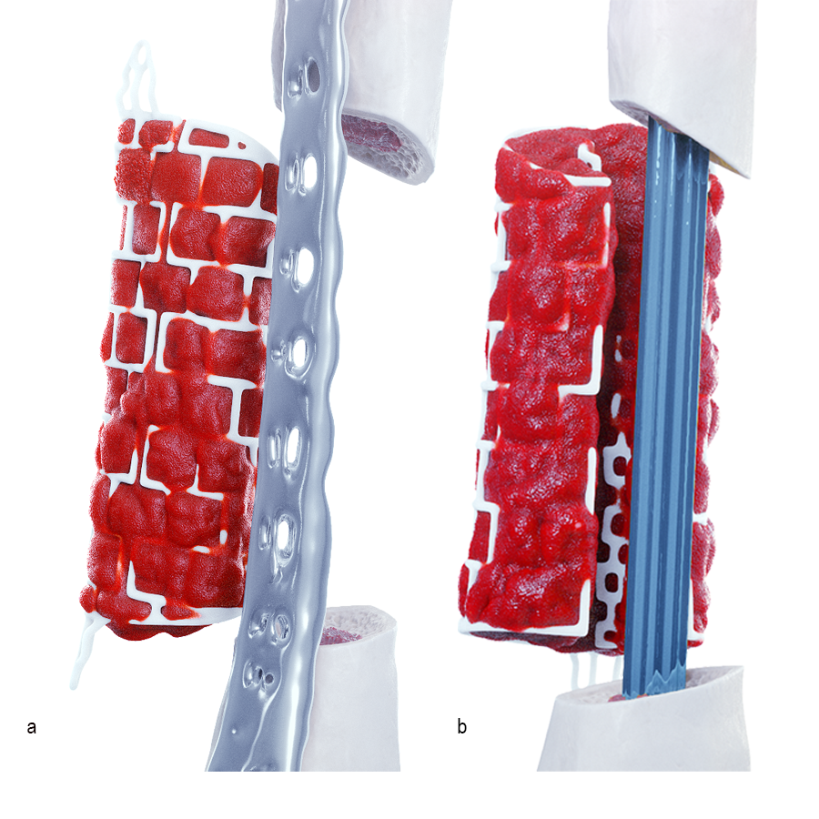 Long Bone Graft Cage