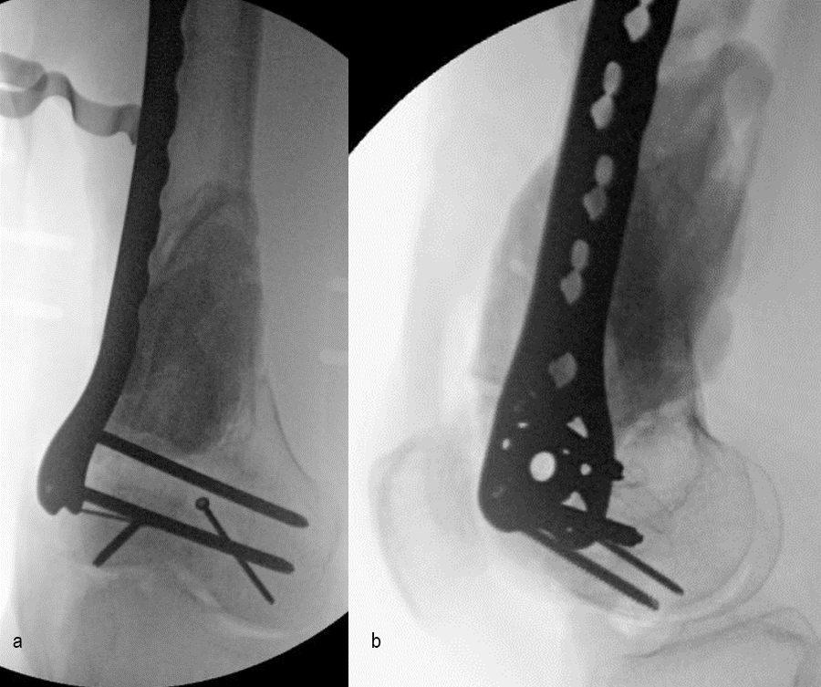 Revision surgery x-rays