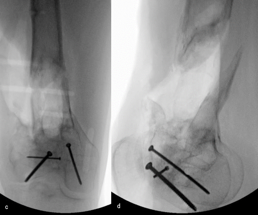 Revision surgery x-rays