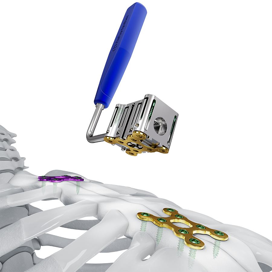 MatrixSTERNUM™ Fixation System: multi-hole Screw Guides and low-profile plates