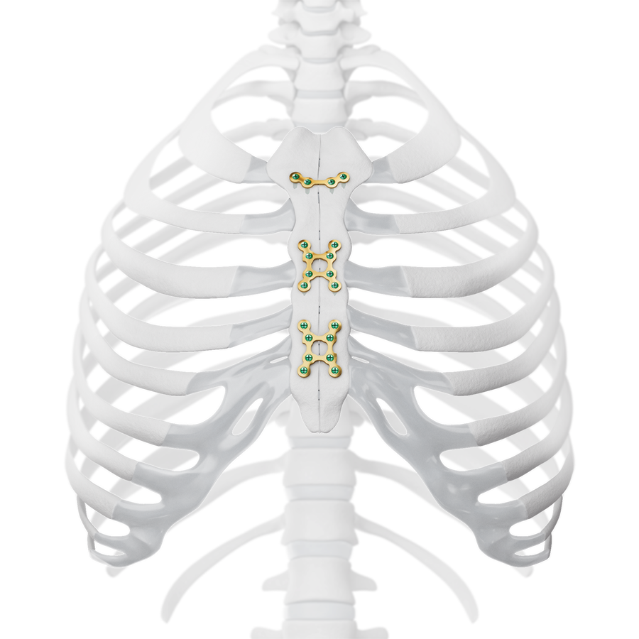 Plates of the MatrixSTERNUM™ Fixation System include the Angled Plate (4 holes, top) and the X-Plate (8 holes, middle and bottom).