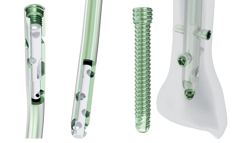 Expert Tibia Nailing - Auxein: Pioneering Orthopedic Solutions Worldwide