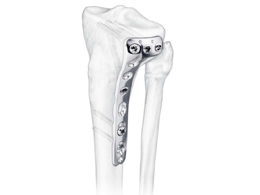 LCP Proximal Tibia Plate 4.5