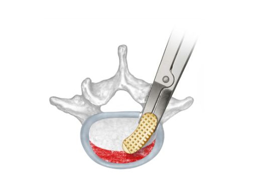 t-plif_spacer_system_1