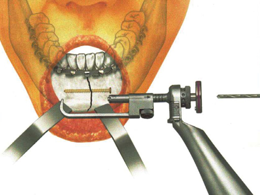 uni_trocar_device_incl_lag_screw_device_1