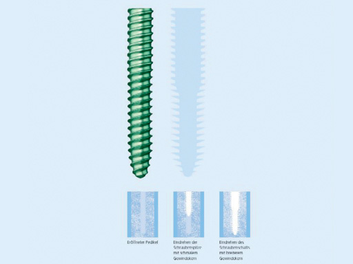 ClickX_Dual_Core_Pedicale_Screw_1