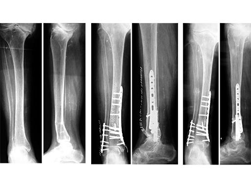 lcp_distal_tibia_plate_2