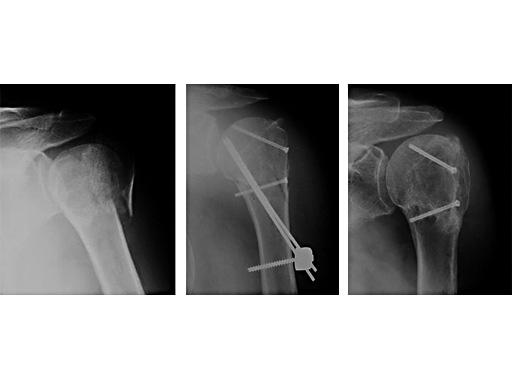 study_humerusblock_1