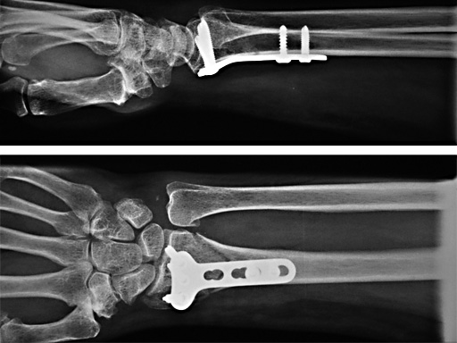 study_lcp_distal_radius_1