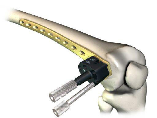 LCP Distal Femur