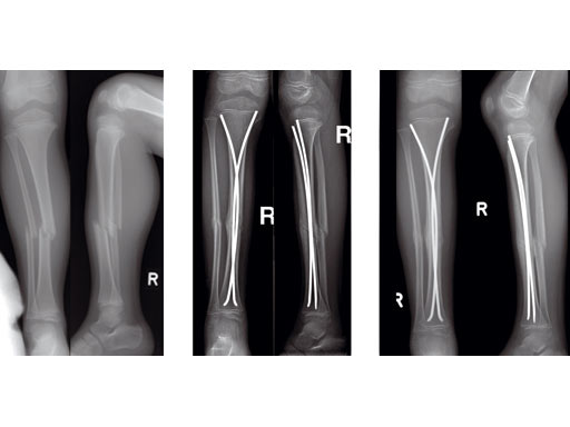 Metals | Free Full-Text | Failure Analysis of a Femoral Cephalomedullary  Nail