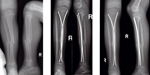 Procedure of reamed IL nailing. Left For type A3 fractures, an... |  Download Scientific Diagram