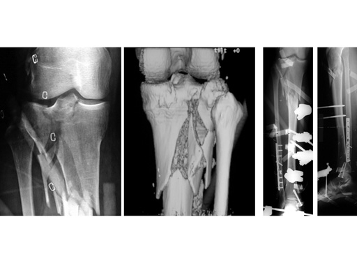 prox_lateral_tibia_liss_1