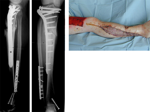 prox_lateral_tibia_liss_2