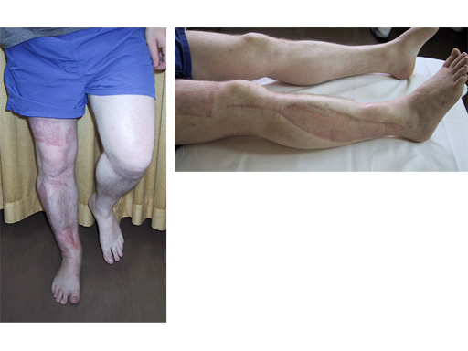 prox_lateral_tibia_liss_4