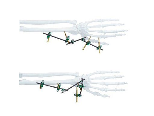 small_external_fixator_sys_1