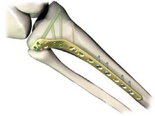 LCP Proximal Lateral Tibia