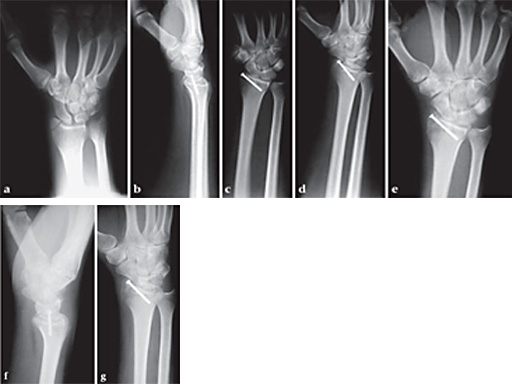 2-4mmCannulatedScrewSystem