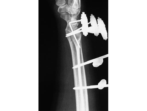 E-1-Tag-post-op-seitl