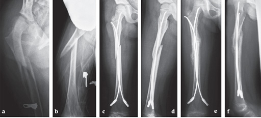 Mechanical failures after fixation with proximal femoral nail and risk | CIA