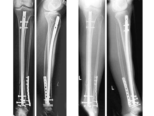 TIBIA FRACTURE CAUSED BY A BROKEN SCREW DURING INTERLOCKING INTRAMEDULLARY  NAIL EXTRACTION | Orthopedics