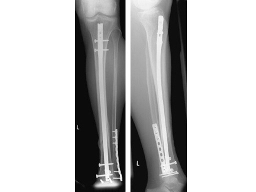 Extra-articular distal tibial fractures, is interlocking nailing an option?  A prospective study of 147 cases | Chinese Journal of Traumatology