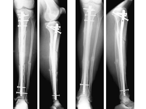 Tibial Shaft Fractures
