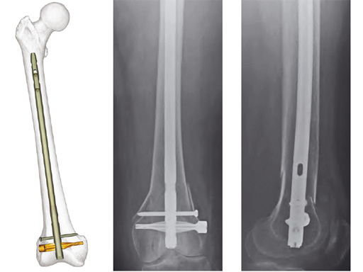 Expert_Retro_Ante_Femoral_2