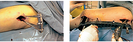 hohmann-retractor-holder-case