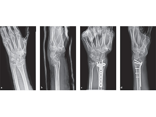lcp-extraarticulaar-v-case