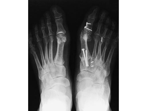 Locking_2_hole_plate_003