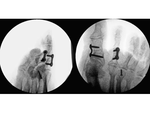 Locking_2_hole_plate_005