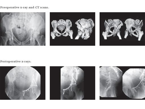 new_pelvic_set_11