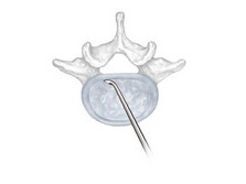 ProPrep lumbar disc preparation instrument set