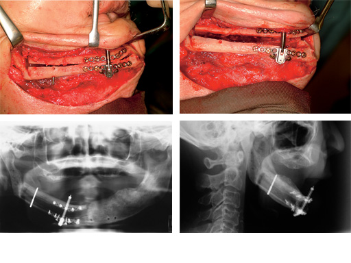 Alveolar-Distractor-case-01